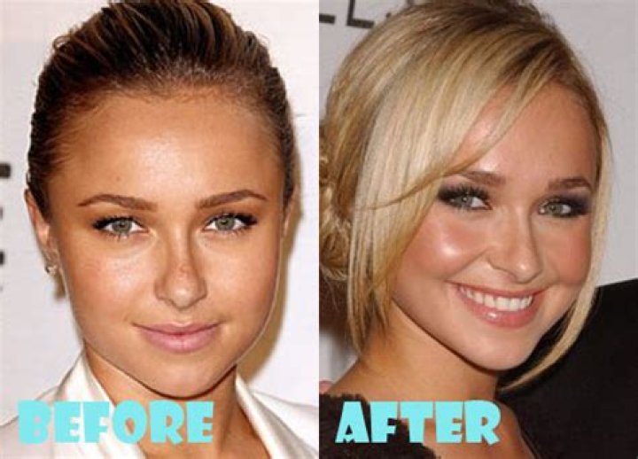 Did Hayden Panettiere Get Plastic Surgery: Before & After!