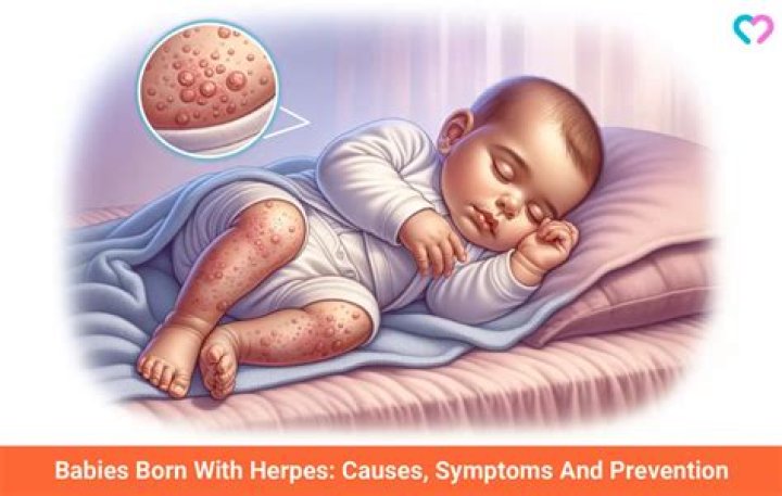 Maternal Antibodies Offer Protection Against Herpes in Newborns – Contagion Live