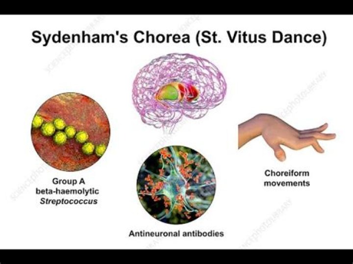 Medicine: Fever v. St. Vitus's Dance